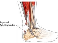 Torn tendons recover faster with imaginary training